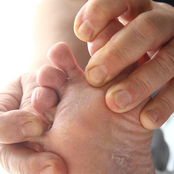 Houba postihuje kůži mezi prsty na nohou