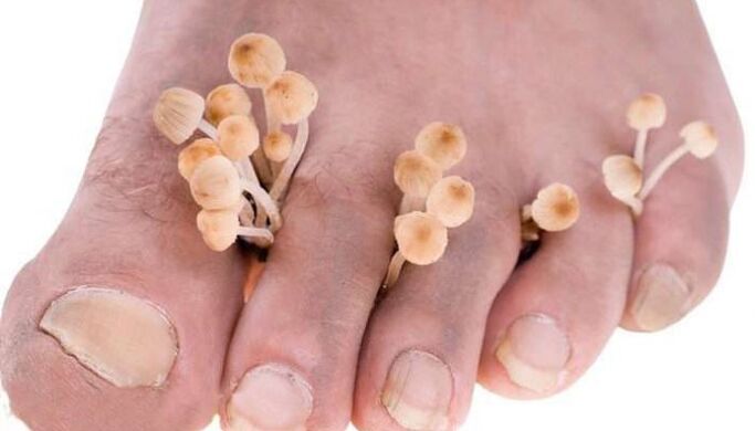 houba mezi prsty na nohou