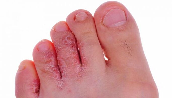 plísňová infekce kůže prstů na nohou