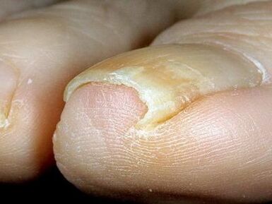 Vzhled nehtů na nohou infikovaných houbou