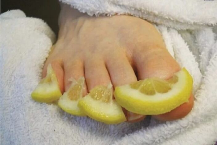 Obklady z citronových kapek - lidový lék na plíseň nehtů na nohou